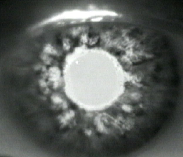 Laser Pupilloplasty